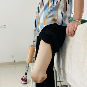 跪腿假肢技术新突破，华西假肢矫形中心跪腿假肢制作成功！