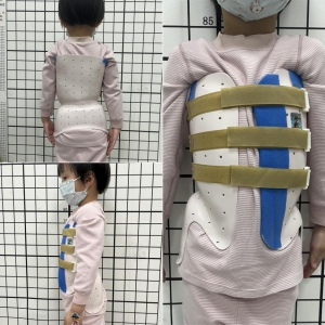 一例婴幼儿特发性脊柱侧凸保守治疗效果观察的病案分享